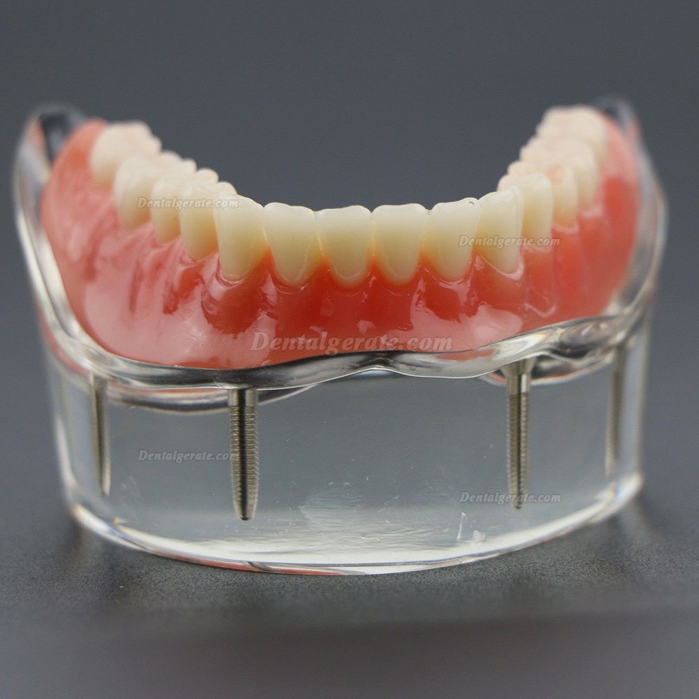 Dental Lower Z&auml;hne Demo-Studienmodell 6002 02 Overdenture Unten 4 Implantate